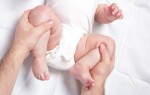 Несимметричные складки на ножках новорожденного